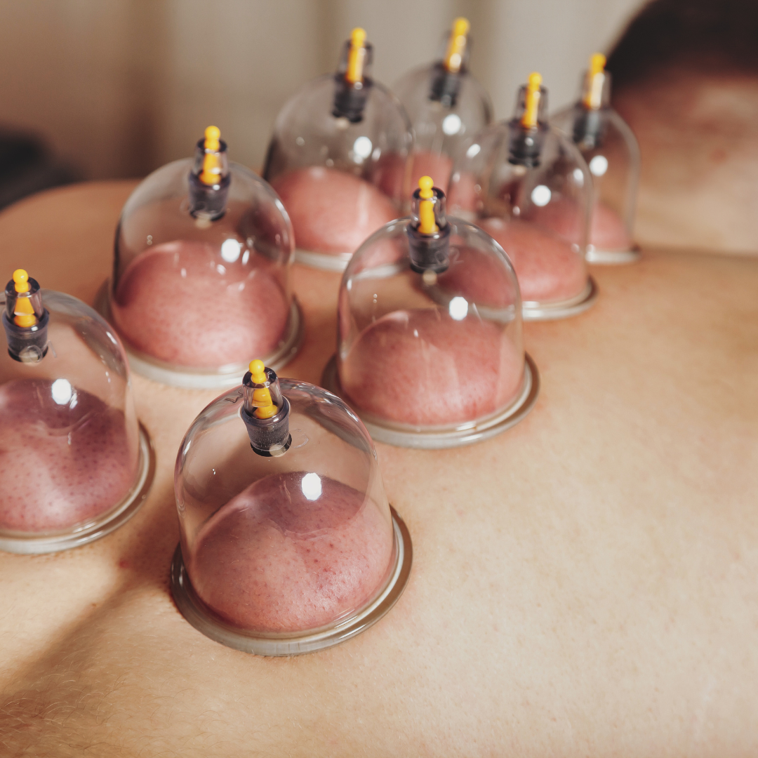 cupping